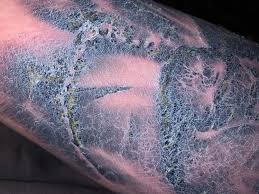 Health Issues And Tattoos TattooNOW