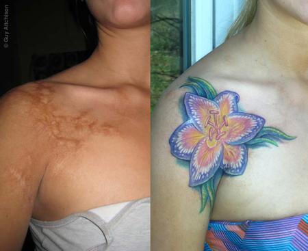 Guy Aitchison - Nicole, childhood coffee burn scar, before and after